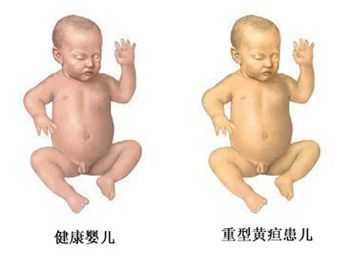 新生儿得黄疸怎么办 不可轻视的新生儿黄疸 www.91yuer.com